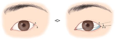 Figure 1 From Cosmetic Lateral Canthoplasty Lateral Canthoplasty To