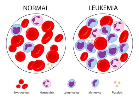 Comparaison Du Sang Normal Et De La Leuc Mie Cancer Du Sang Globules