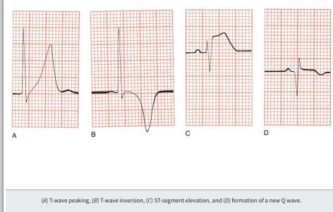 Ecg Flashcards Quizlet