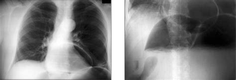 Two Large Air Bubbles Are Seen In The Lower Mediastinum And Below The