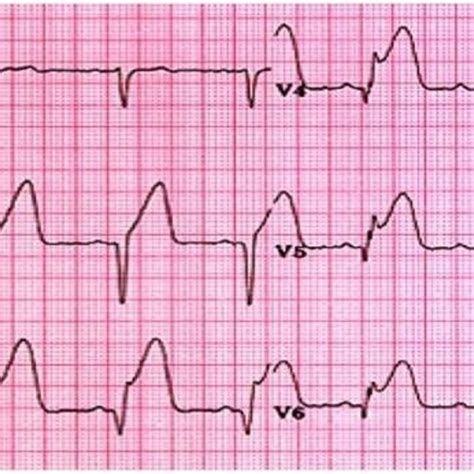 Case Ecg Shows A Normal Sinus Rhythm With Diffuse Anterior