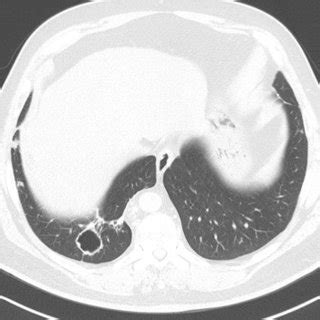 Initial High Resolution Computed Tomographic Image Demonstrating Right