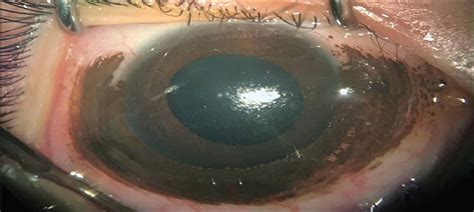 A rare case of giant conjunctival nevus in an 11-month-old c ...