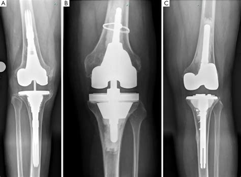 Robotic knee replacement surgery and everything related to it - Dr. Şetin Işık