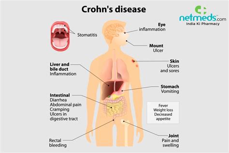 Crohns Disease Similar Conditions Prnso