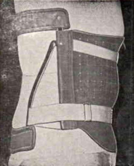 Figure The Williams Brace As Advertised In O P Digital Resource