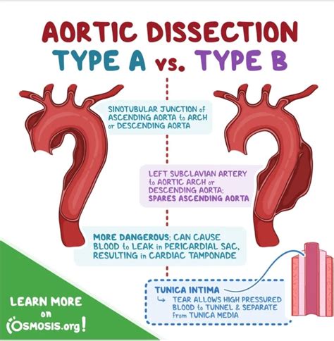 Aortic Dissection 101