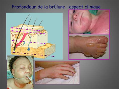 PPT Les brûlures prise en charge chirurgicale PowerPoint