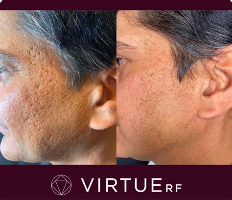 Virtue Rf Microneedling Skin Rejuvenation Method Rochester Ny