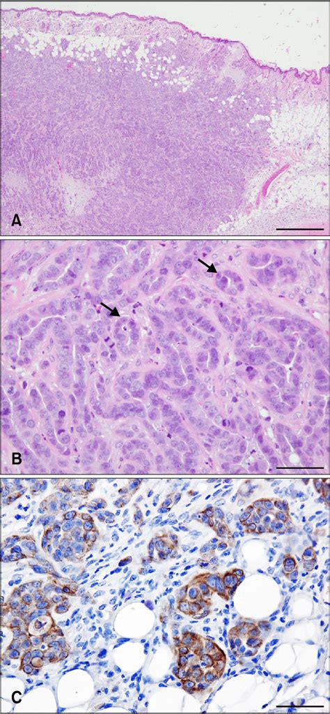 Snp Mammary Gland Tumor From Subcutaneous Tumor Tissue Nodcb17 Prkdc