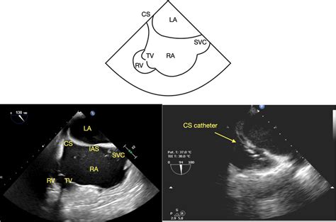 Modified Bicaval View Of The Coronary Sinus With And Without A Coronary