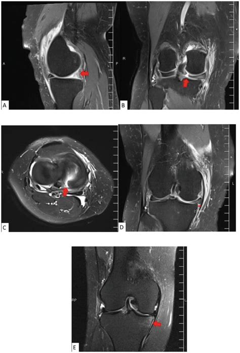 Meniscus Root Tear Mri