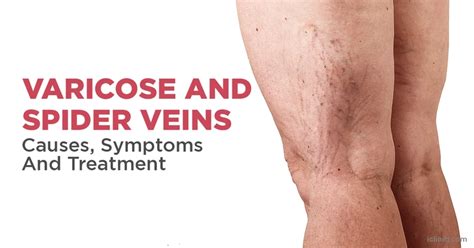 Varicose Veins And Spider Veins Spider Veins