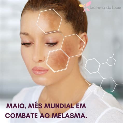 Dra Fernanda Lopes Dermatologia Blog Melasma As Causas Como