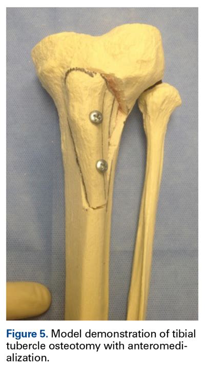 A Systematic Review Of 21 Tibial Tubercle Osteotomy Studies And More