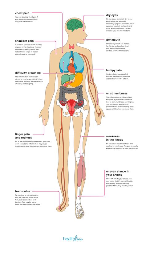 11 Effects of Rheumatoid Arthritis on the Body