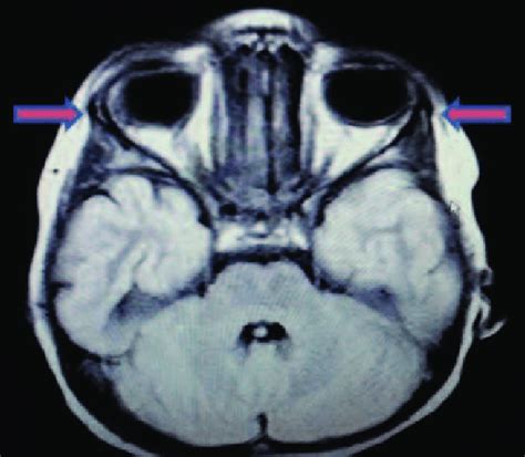 Orbital Mri Shows Bilateral Hypoplastic Lacrimal Glands Red Arrows