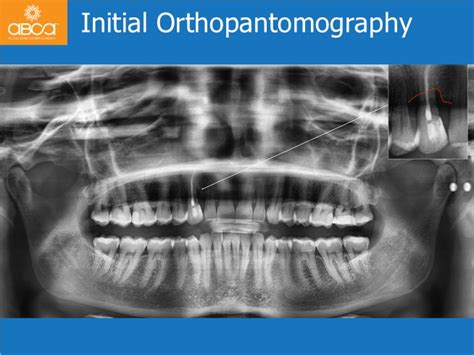 Upper Right Canine Immediate Implant With Immediate Load Augma