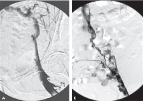 Figure From Pharmacomechanical Catheter Directed Thrombolysis For