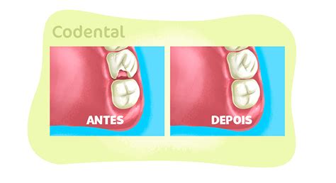 Restaura O De Dente Tudo Sobre O Procedimento