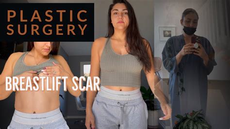 Breastlift Scar Plastic Surgery Update 13years Post Op Youtube