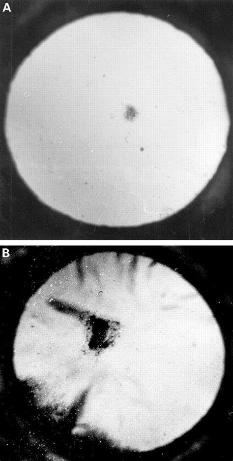 A Clinical Study Of Radiation Cataract Formation In Adult Life