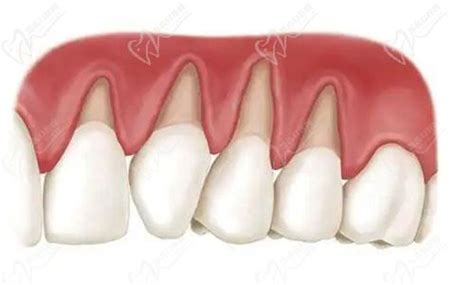 找到了正常牙齿和牙龈萎缩对比图，解释下牙龈萎缩能长出来吗皓齿口腔网