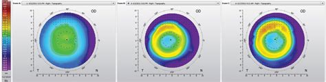 Orthokeratology Principles Lessons Cases