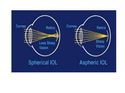 Types of iol