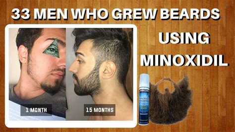 Minoxidil Before And After Beard Result Minoxidil For Beard Growth