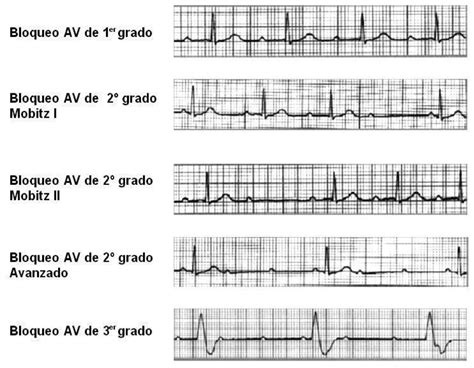 ECG 8 1 Bloqueos Auriculoventriculares Cardio Science