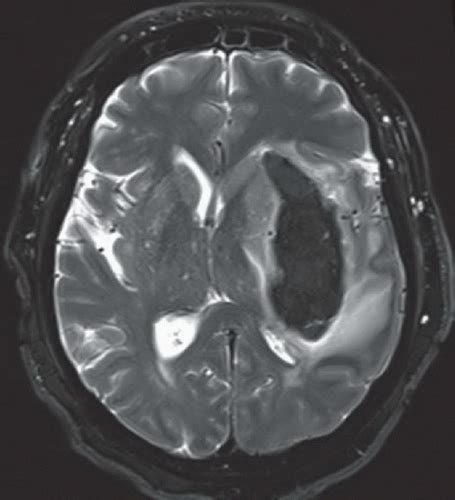 Hypertensive Basal Ganglia Hemorrhage Radiology Key