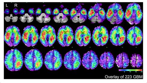 Figure From A Voxel Based Radiographic Analysis Reveals The