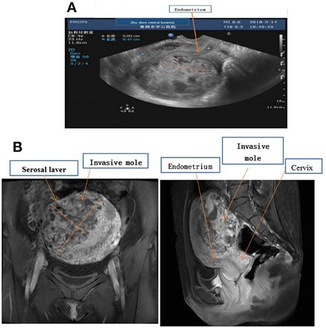 Choriocarcinoma Uterus