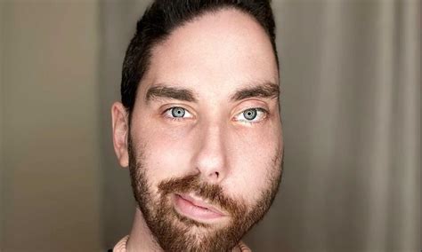 Un Influencer Gay Se Sincera Sobre Sus Citas Con Un Defecto Facial De Nacimiento CromosomaX