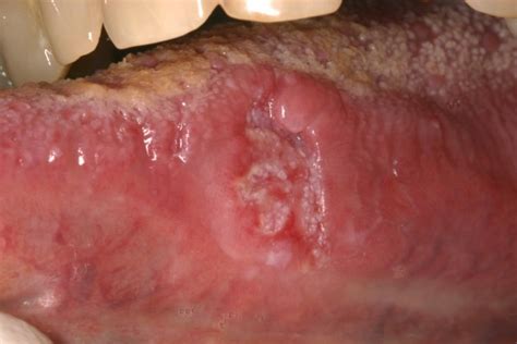 Oral Cavity And Oropharyngeal Squamous Cell Carcinomaan Update Chi