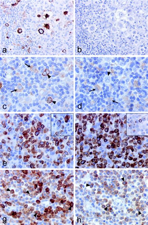 Analysis Of Interleukin 27 Ebi3p28 Expression In Epstein Barr Virus