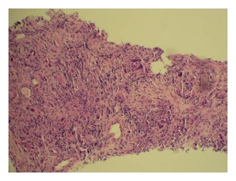 Needle Core Biopsy Of Left Upper Lung Lobe Mass A B And C Hande