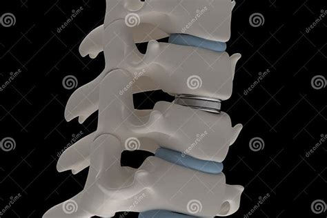 Artificial Intervertebral Disc Prosthesis is Installed between T Stock Illustration ...