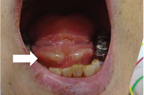 The Double Tongue Sign Cleveland Clinic Journal Of Medicine