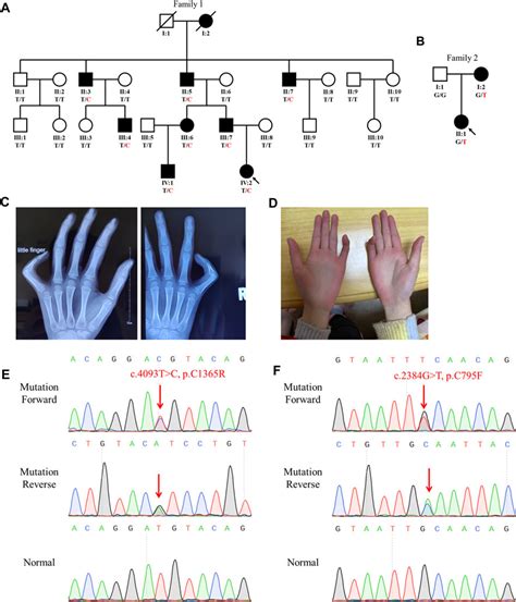 Frontiers Case Report Identification Of Novel Fibrillin 2 Variants