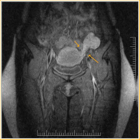 Pelvic Congestion Syndrome MRI Radiology Imaging