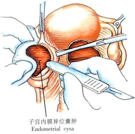 子宮內膜異位症——一個可以引起不孕的疾病！ 每日頭條