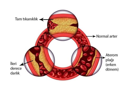 Kalp damar hastalığı nedir Risk faktörleri nelerdir Nasıl önlenir