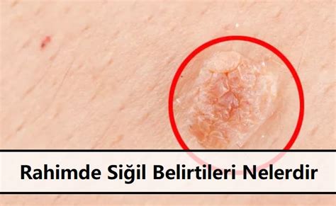 Cinsel Organda Siğil Bitkisel Tedavisi Cinselbilgim