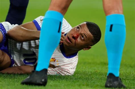 Kylian Mbappe Meninggalkan Lapangan Dengan Hidung Patah Dan Baju