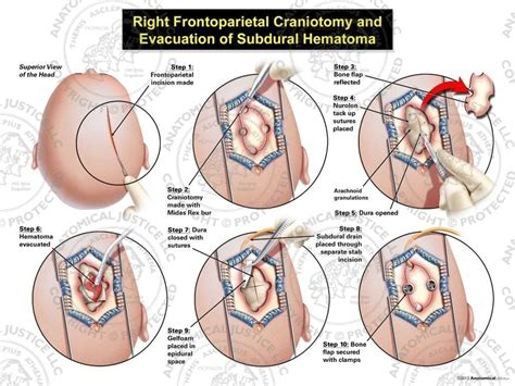 Right Frontoparietal Craniotomy And Evacuation Of Subdural Hematoma