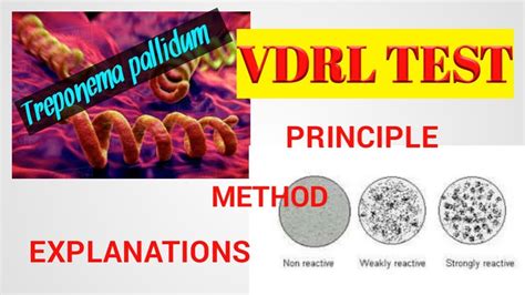 Vdrl Testvdrl Test Proceduretreponema Pallidum Microbilogysyphilis