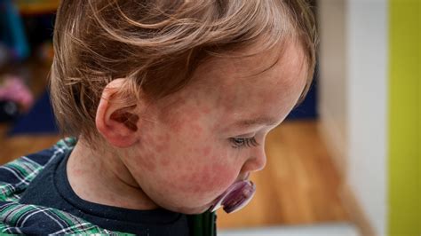 Aumenta L Allarme Per Morbillo E Pertosse Crescono I Casi In Tutta