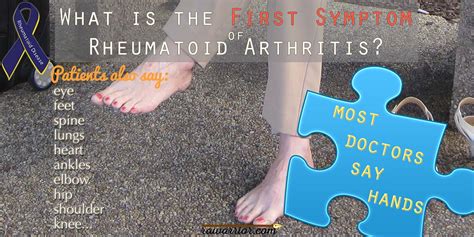 What Is The First Symptom Of Rheumatoid Arthritis Rheumatoid Arthritis Warrior